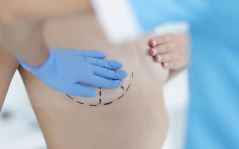 Breast Lift Scars: Where They Come From and How They Heal